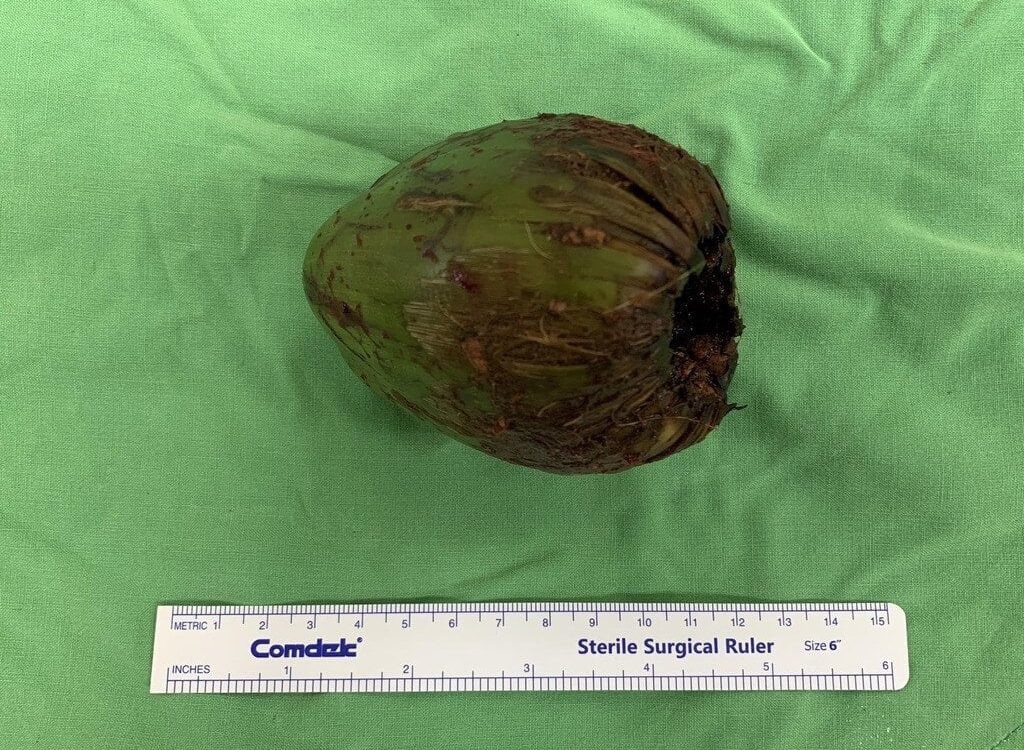 Man in Taiwan gets coconut stuck in rectum, visits hospital after he struggles to pee