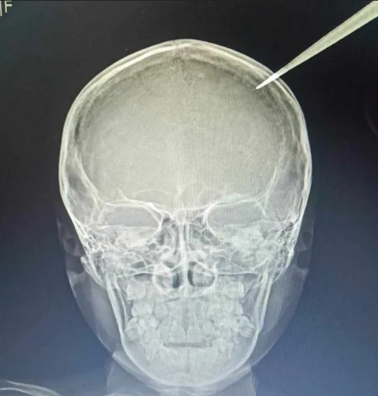 Scissors penetrate Thai girl's skull after 4-year-old brother throws them to imitate TV show