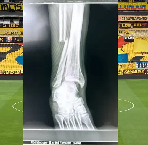 ¡Escalofriante! Radiografía muestra cómo quedó un hueso de Joao Rojas, quien sufrió una fuerte lesión durante el partido contra Sao Paulo (FOTO)